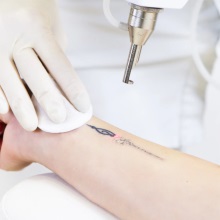 Скидка до 30% на лазерное удаление татуировок и татуажа