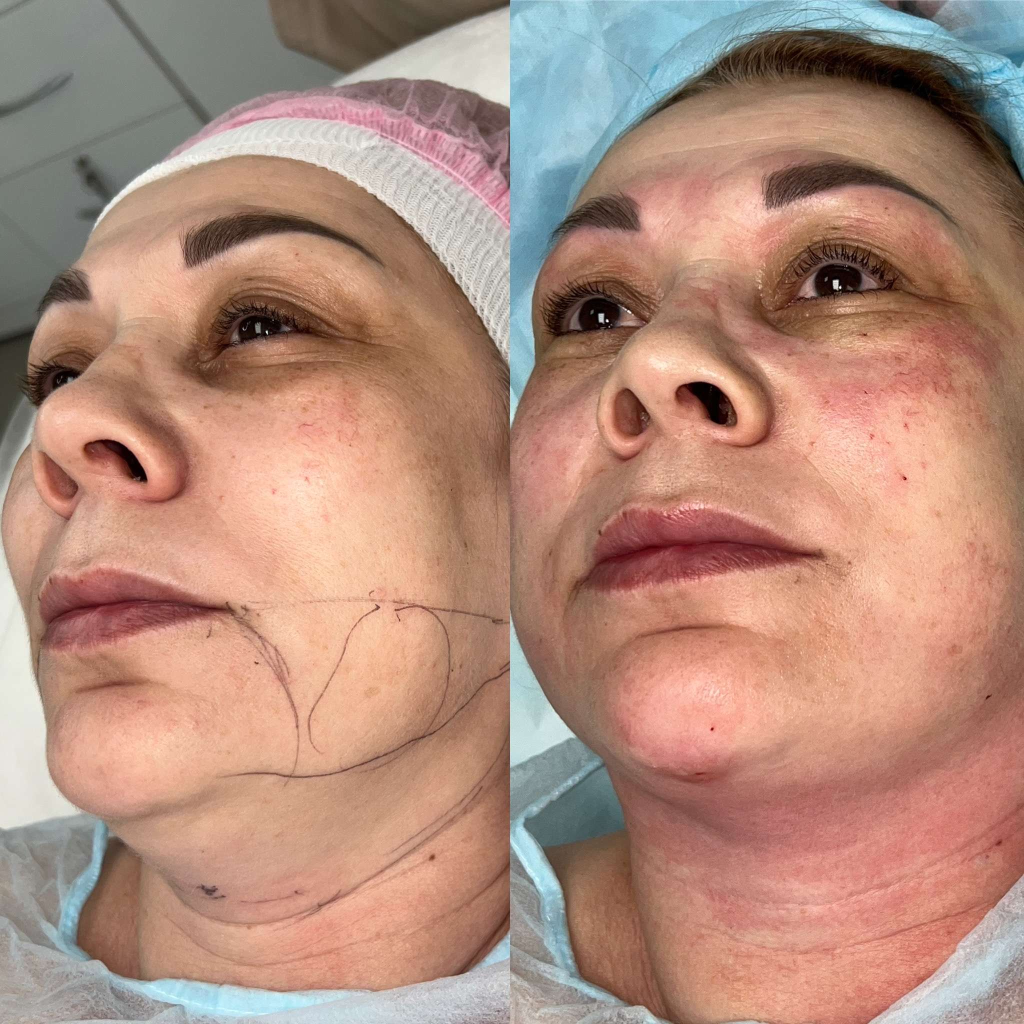 До Липоредукция FaceTite подчелюстной зоны