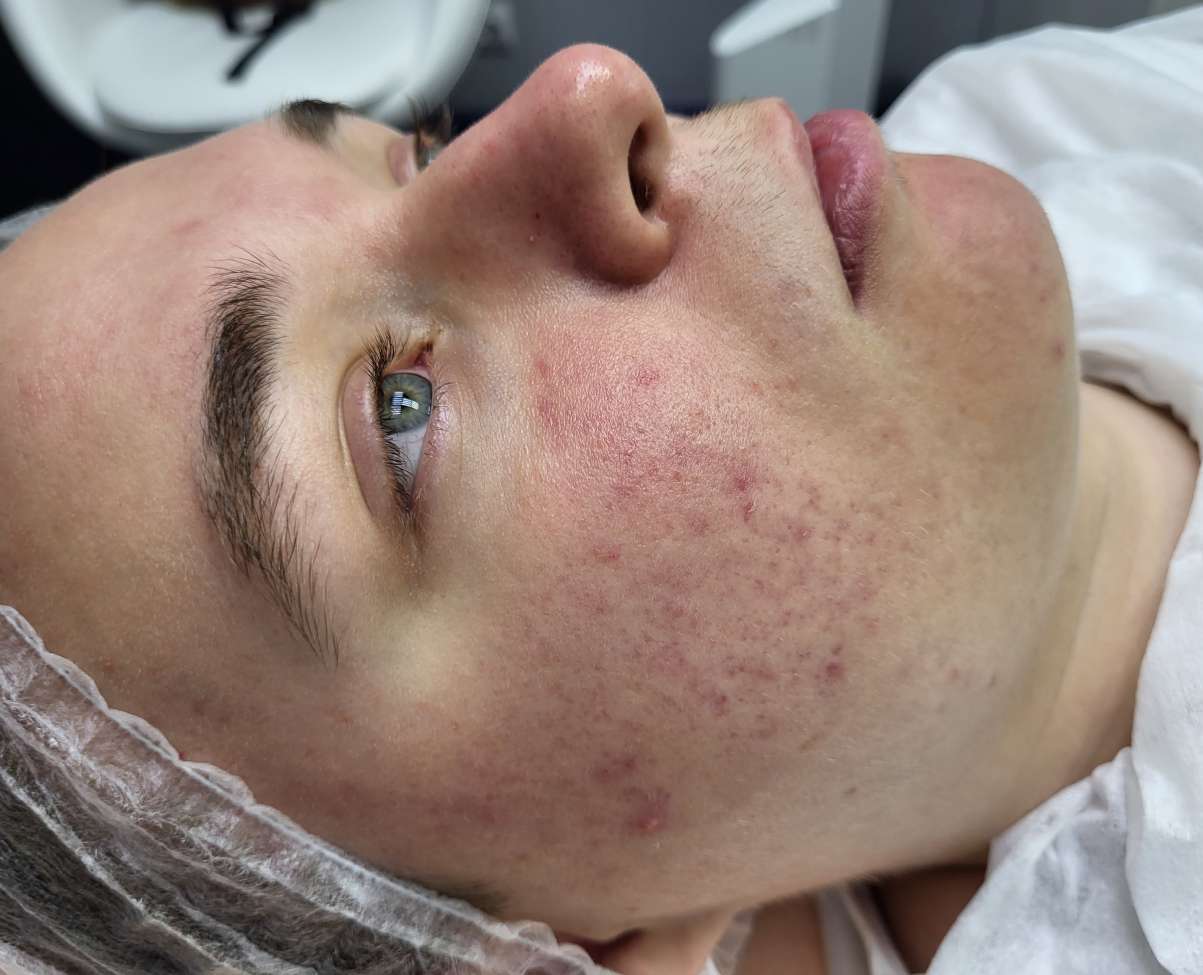 После Фотодинамическая терапия Revixan