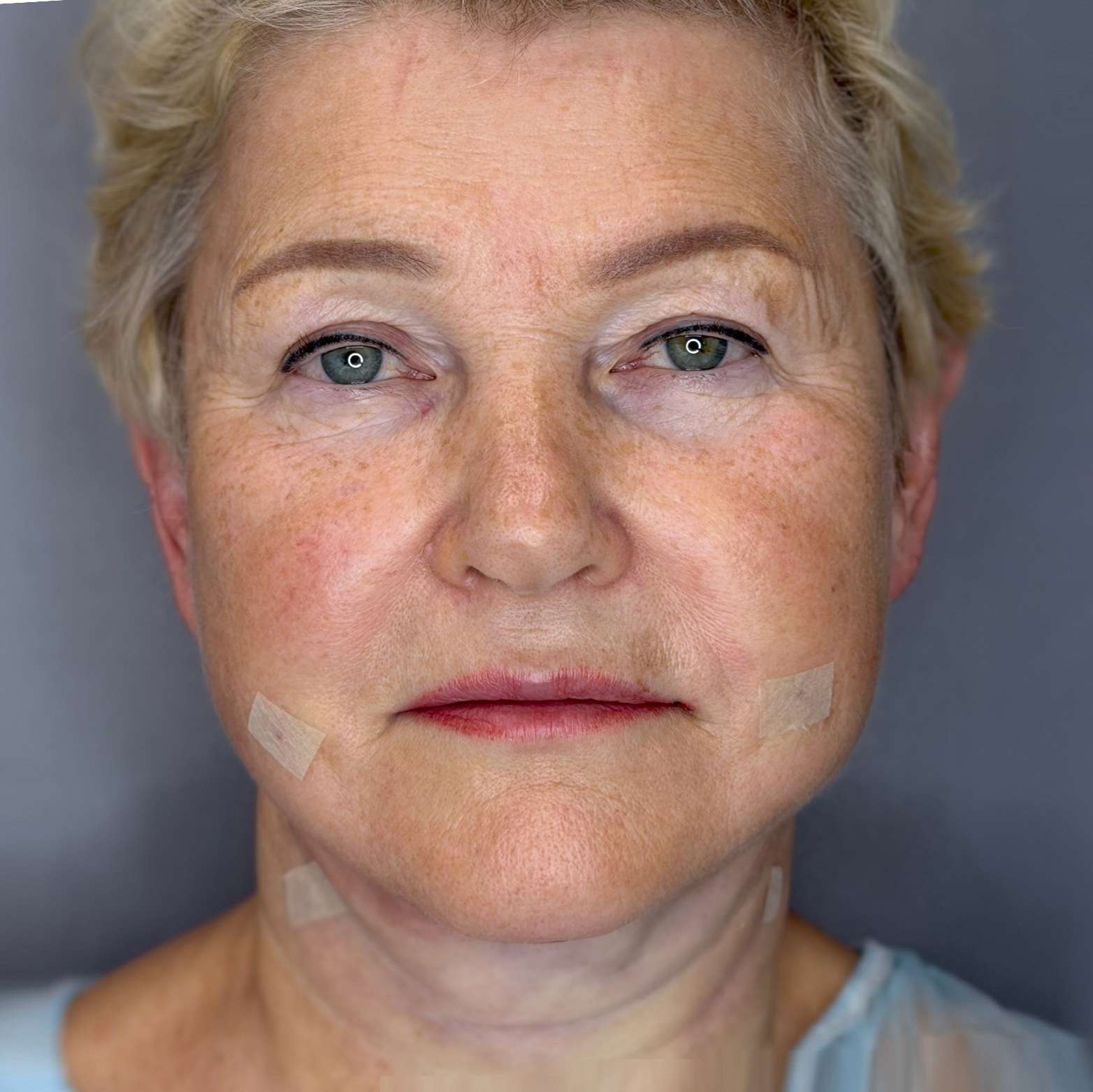 После Facetite средняя, нижняя трети, подчелюстная зона, шея