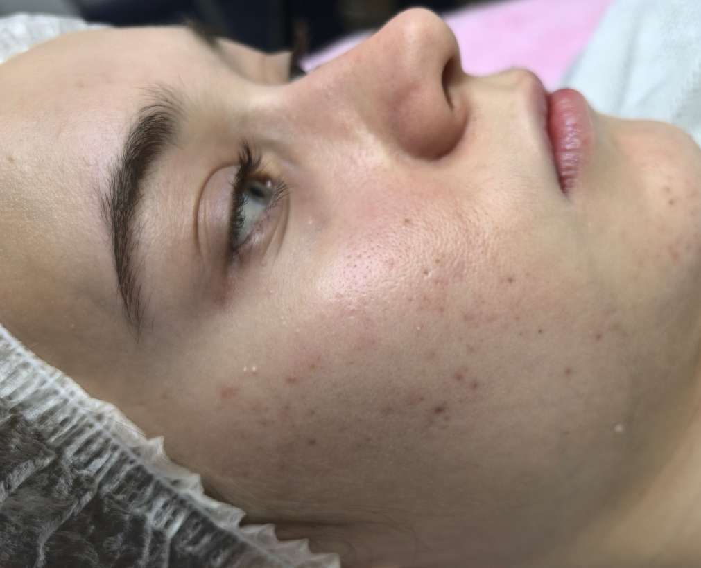 После Фотодинамическая терапия Revixan