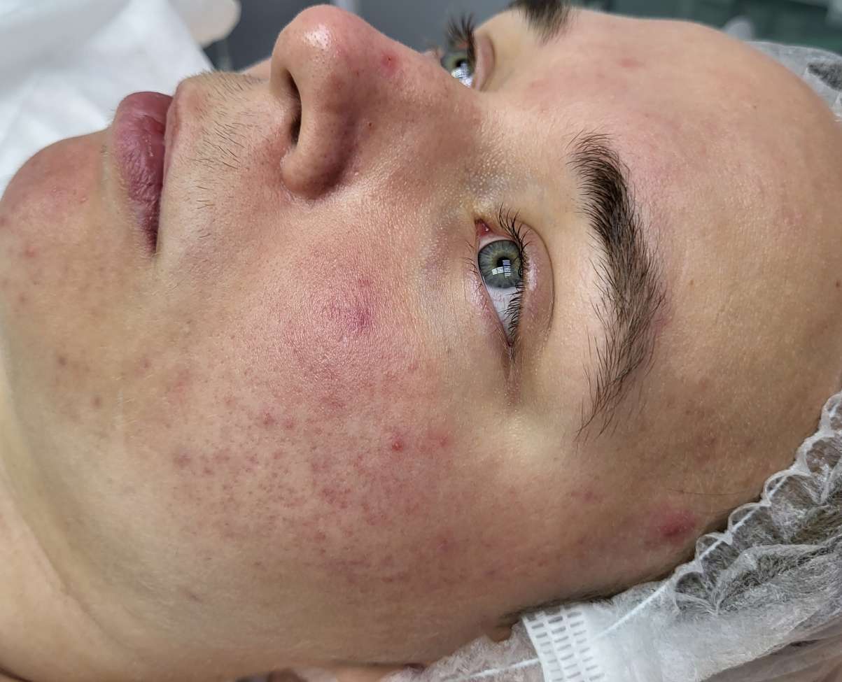 После Фотодинамическая терапия Revixan