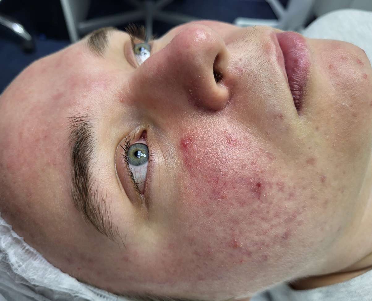 До Фотодинамическая терапия Revixan