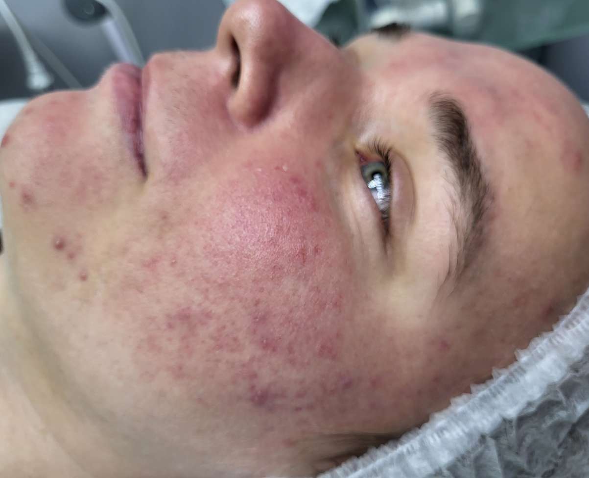 До Фотодинамическая терапия Revixan