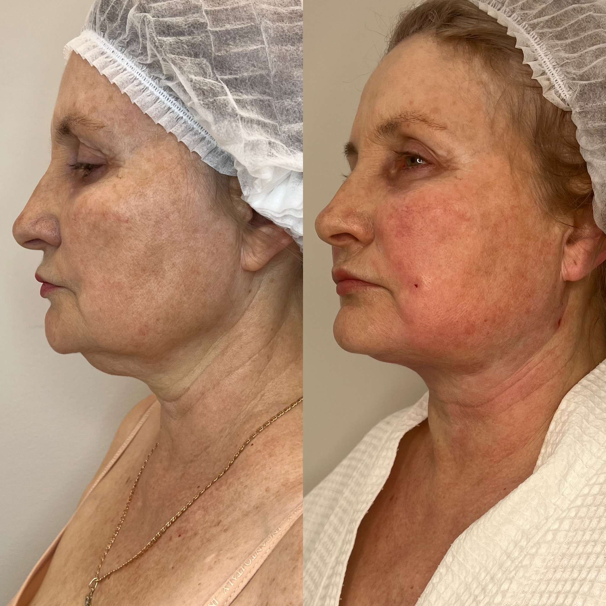 До FaceTite среднещечной области, нижней трети, подчелюстной зоны, шеи