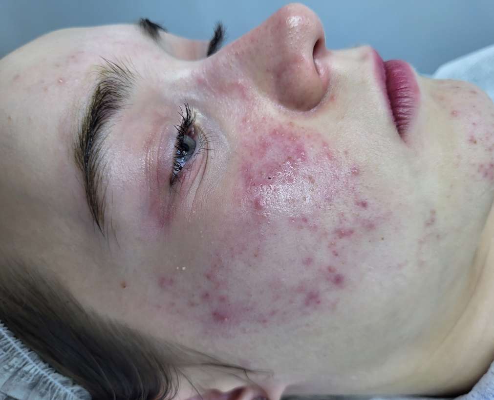 До Фотодинамическая терапия Revixan