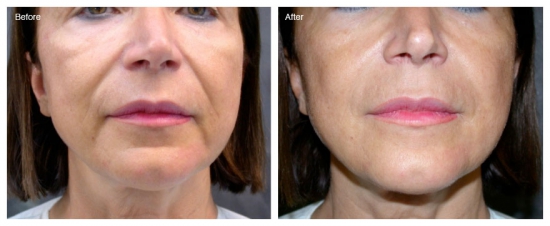 плазмолифтинг лица - фото до и после