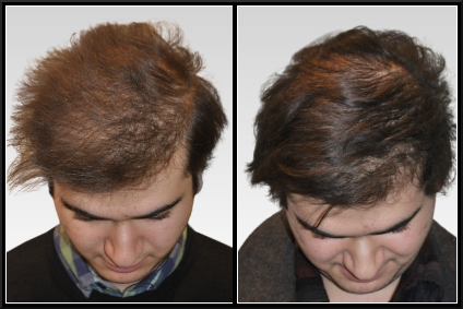 плазмолифтинг для волос - фото до и после